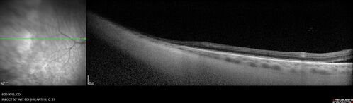 Peripheral exudative hemorrhagic chorioretinopathy - PECHR - Subfoveal fluid
85 year old female with 
Fluctuating   vision in the right eye.  
VA 20/200 OD, 20/32 OS
