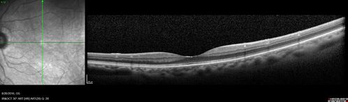 Peripheral exudative hemorrhagic chorioretinopathy - PECHR - Subfoveal fluid
85 year old female with 
Fluctuating   vision in the right eye.  
VA 20/200 OD, 20/32 OS

