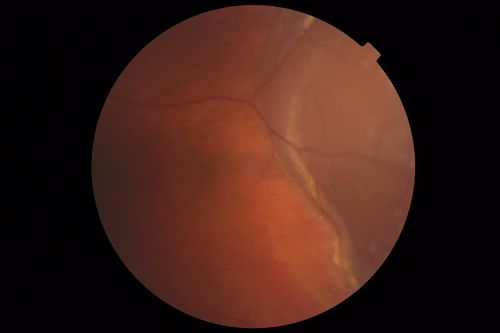 Peripheral Exudative Hemorrhagic Chorioretinopathy
93 year old female with shadow in side vision in the left eye.  Referred for retinal detachment - Exudative lesion subsided in about 6 months without treatment.
Vision 20/63 OD and 20/100 OS (from dry AMD)
