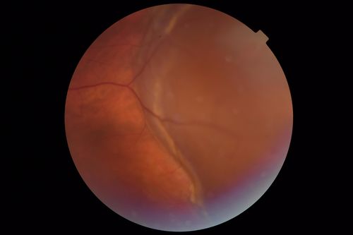 Peripheral Exudative Hemorrhagic Chorioretinopathy
93 year old female with shadow in side vision in the left eye.  Referred for retinal detachment - Exudative lesion subsided in about 6 months without treatment.
Vision 20/63 OD and 20/100 OS (from dry AMD)
