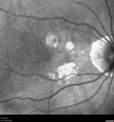 Peripheral Exudative Hemorrhagic Chorioretinopathy
93 year old female with shadow in side vision in the left eye.  Referred for retinal detachment - Exudative lesion subsided in about 6 months without treatment.
Vision 20/63 OD and 20/100 OS (from dry AMD)
