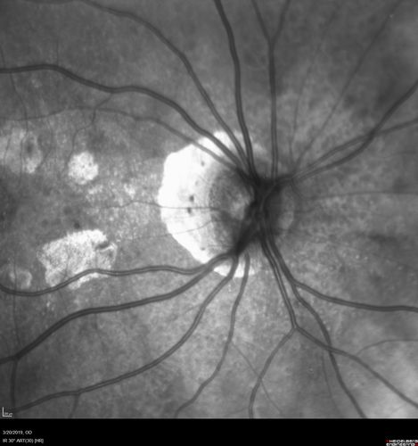 Peripheral Exudative Hemorrhagic Chorioretinopathy
93 year old female with shadow in side vision in the left eye.  Referred for retinal detachment - Exudative lesion subsided in about 6 months without treatment.
Vision 20/63 OD and 20/100 OS (from dry AMD)
