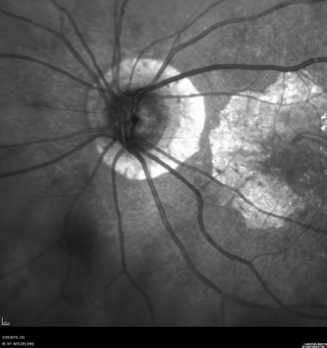 Peripheral Exudative Hemorrhagic Chorioretinopathy
93 year old female with shadow in side vision in the left eye.  Referred for retinal detachment - Exudative lesion subsided in about 6 months without treatment.
Vision 20/63 OD and 20/100 OS (from dry AMD)
