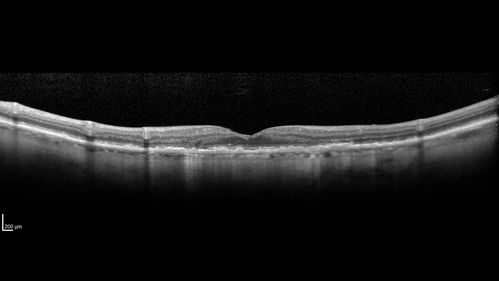 Peripheral Exudative Hemorrhagic Chorioretinopathy
93 year old female with shadow in side vision in the left eye.  Referred for retinal detachment - Exudative lesion subsided in about 6 months without treatment.
Vision 20/63 OD and 20/100 OS (from dry AMD)
