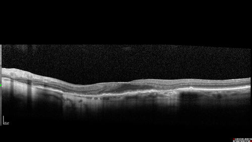Peripheral Exudative Hemorrhagic Chorioretinopathy
93 year old female with shadow in side vision in the left eye.  Referred for retinal detachment - Exudative lesion subsided in about 6 months without treatment.
Vision 20/63 OD and 20/100 OS (from dry AMD)
