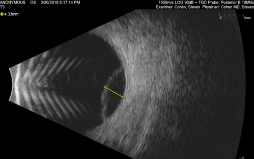 Peripheral Exudative Hemorrhagic Chorioretinopathy
93 year old female with shadow in side vision in the left eye.  Referred for retinal detachment - Exudative lesion subsided in about 6 months without treatment.
Vision 20/63 OD and 20/100 OS (from dry AMD)
