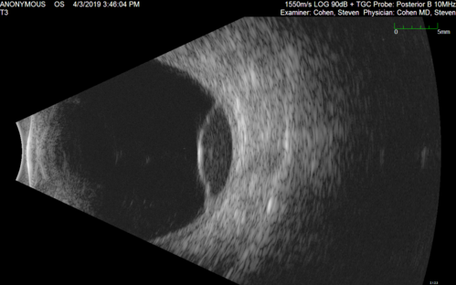 Peripheral Exudative Hemorrhagic Chorioretinopathy
93 year old female with shadow in side vision in the left eye.  Referred for retinal detachment - Exudative lesion subsided in about 6 months without treatment.
Vision 20/63 OD and 20/100 OS (from dry AMD)

