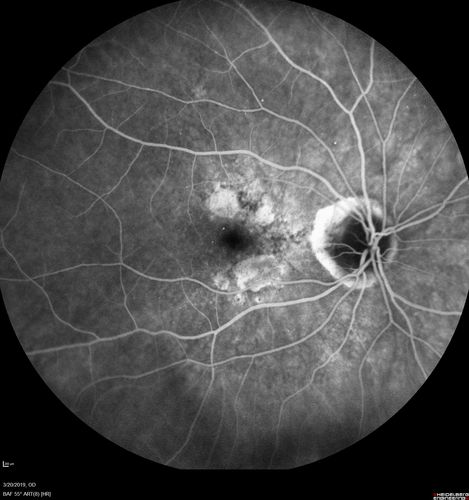 Peripheral Exudative Hemorrhagic Chorioretinopathy
93 year old female with shadow in side vision in the left eye.  Referred for retinal detachment - Exudative lesion subsided in about 6 months without treatment.
Vision 20/63 OD and 20/100 OS (from dry AMD)
