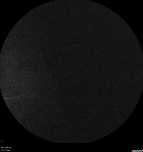 Peripheral Exudative Hemorrhagic Chorioretinopathy
93 year old female with shadow in side vision in the left eye.  Referred for retinal detachment - Exudative lesion subsided in about 6 months without treatment.
Vision 20/63 OD and 20/100 OS (from dry AMD)
