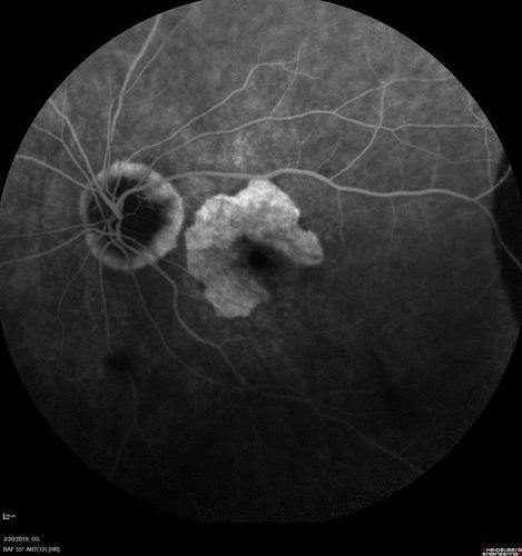 Peripheral Exudative Hemorrhagic Chorioretinopathy
93 year old female with shadow in side vision in the left eye.  Referred for retinal detachment - Exudative lesion subsided in about 6 months without treatment.
Vision 20/63 OD and 20/100 OS (from dry AMD)

