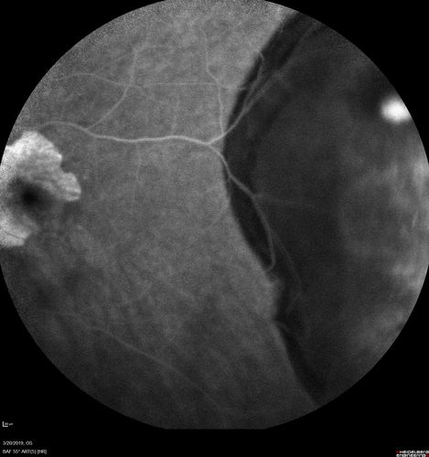 Peripheral Exudative Hemorrhagic Chorioretinopathy
93 year old female with shadow in side vision in the left eye.  Referred for retinal detachment - Exudative lesion subsided in about 6 months without treatment.
Vision 20/63 OD and 20/100 OS (from dry AMD)

