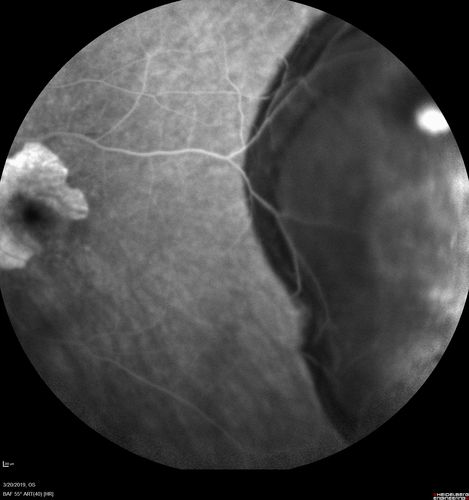 Peripheral Exudative Hemorrhagic Chorioretinopathy
93 year old female with shadow in side vision in the left eye.  Referred for retinal detachment - Exudative lesion subsided in about 6 months without treatment.
Vision 20/63 OD and 20/100 OS (from dry AMD)
