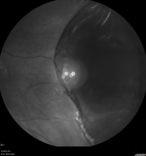 Peripheral Exudative Hemorrhagic Chorioretinopathy
93 year old female with shadow in side vision in the left eye.  Referred for retinal detachment - Exudative lesion subsided in about 6 months without treatment.
Vision 20/63 OD and 20/100 OS (from dry AMD)
