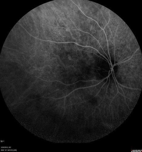 Peripheral Exudative Hemorrhagic Chorioretinopathy
93 year old female with shadow in side vision in the left eye.  Referred for retinal detachment - Exudative lesion subsided in about 6 months without treatment.
Vision 20/63 OD and 20/100 OS (from dry AMD)
