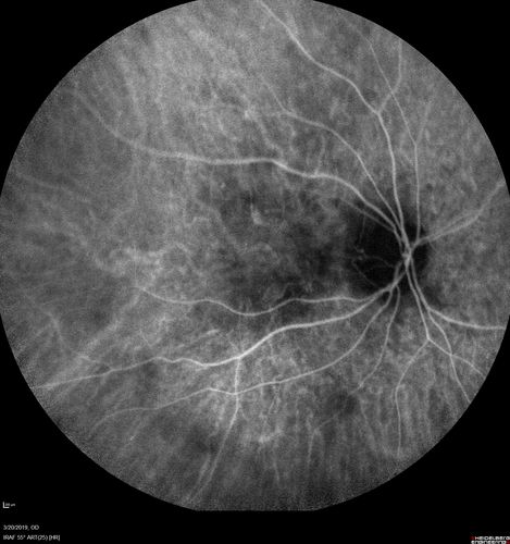 Peripheral Exudative Hemorrhagic Chorioretinopathy
93 year old female with shadow in side vision in the left eye.  Referred for retinal detachment - Exudative lesion subsided in about 6 months without treatment.
Vision 20/63 OD and 20/100 OS (from dry AMD)
