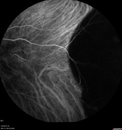 Peripheral Exudative Hemorrhagic Chorioretinopathy
93 year old female with shadow in side vision in the left eye.  Referred for retinal detachment - Exudative lesion subsided in about 6 months without treatment.
Vision 20/63 OD and 20/100 OS (from dry AMD)
