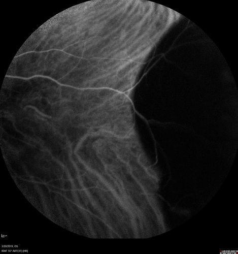 Peripheral Exudative Hemorrhagic Chorioretinopathy
93 year old female with shadow in side vision in the left eye.  Referred for retinal detachment - Exudative lesion subsided in about 6 months without treatment.
Vision 20/63 OD and 20/100 OS (from dry AMD)
