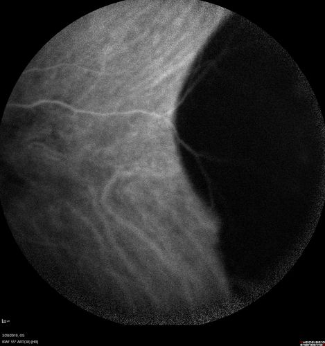 Peripheral Exudative Hemorrhagic Chorioretinopathy
93 year old female with shadow in side vision in the left eye.  Referred for retinal detachment - Exudative lesion subsided in about 6 months without treatment.
Vision 20/63 OD and 20/100 OS (from dry AMD)
