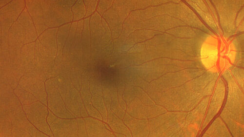 Perivascular Exudative Vascular Complex - Perifoveal Microaneurysm
59 year old man - asymptomatic - not diabetic
