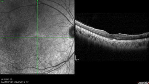 Perivascular Exudative Vascular Complex - Perifoveal Microaneurysm
59 year old man - asymptomatic - not diabetic
