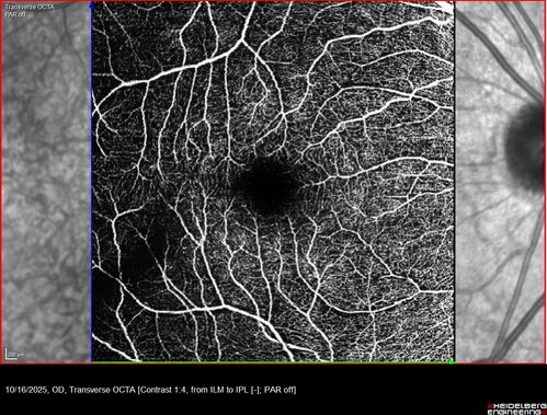 Perivascular Exudative Vascular Complex - Perifoveal Microaneurysm
59 year old man - asymptomatic - not diabetic
