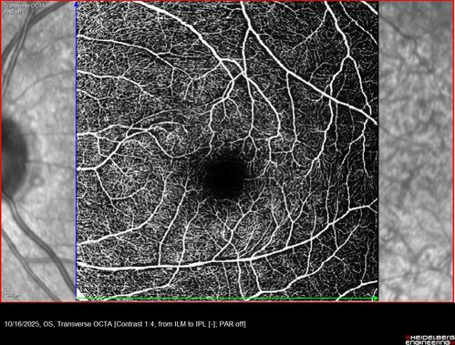 Perivascular Exudative Vascular Complex - Perifoveal Microaneurysm
59 year old man - asymptomatic - not diabetic
