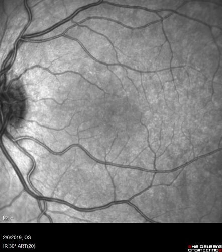 PIC which evolved into Subretinal Fibrosis
27 year old female  VA 20/200 right eye 20/20 left eye.  Right was treated with lucentis.  When extended to 3 months, the fibrosis got much worse
