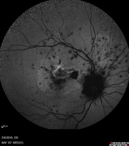 PIC which evolved into Subretinal Fibrosis
27 year old female  VA 20/200 right eye 20/20 left eye.  Right was treated with lucentis.  When extended to 3 months, the fibrosis got much worse
