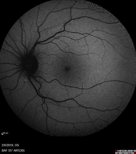 PIC which evolved into Subretinal Fibrosis
27 year old female  VA 20/200 right eye 20/20 left eye.  Right was treated with lucentis.  When extended to 3 months, the fibrosis got much worse
