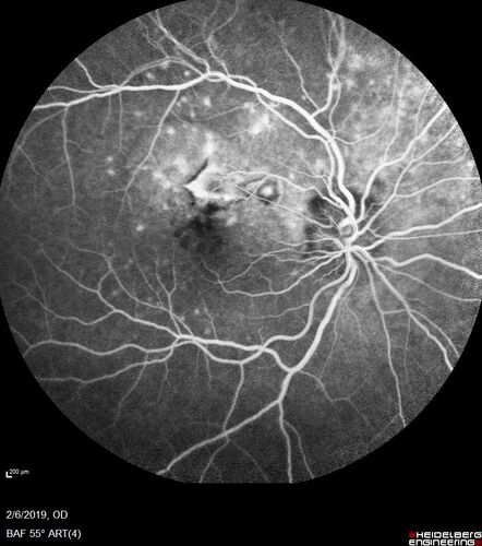 PIC which evolved into Subretinal Fibrosis
27 year old female  VA 20/200 right eye 20/20 left eye.  Right was treated with lucentis.  When extended to 3 months, the fibrosis got much worse
