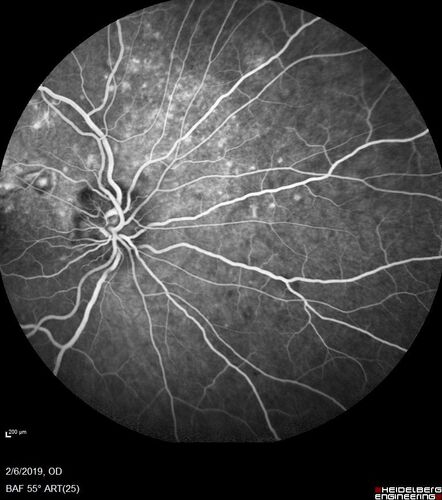 PIC which evolved into Subretinal Fibrosis
27 year old female  VA 20/200 right eye 20/20 left eye.  Right was treated with lucentis.  When extended to 3 months, the fibrosis got much worse
