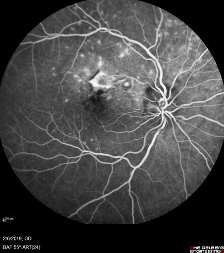 PIC which evolved into Subretinal Fibrosis
27 year old female  VA 20/200 right eye 20/20 left eye.  Right was treated with lucentis.  When extended to 3 months, the fibrosis got much worse
