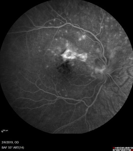 PIC which evolved into Subretinal Fibrosis
27 year old female  VA 20/200 right eye 20/20 left eye.  Right was treated with lucentis.  When extended to 3 months, the fibrosis got much worse
