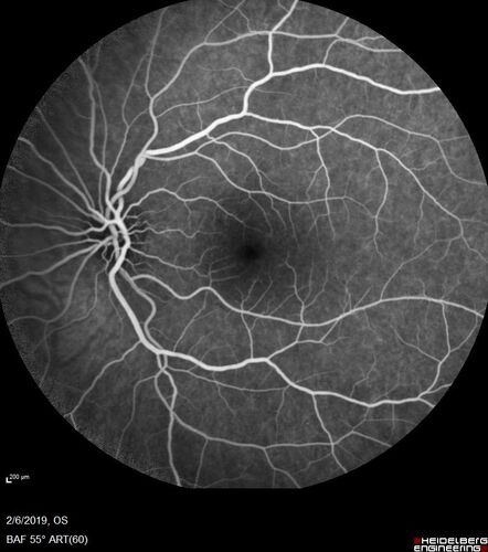 PIC which evolved into Subretinal Fibrosis
27 year old female  VA 20/200 right eye 20/20 left eye.  Right was treated with lucentis.  When extended to 3 months, the fibrosis got much worse
