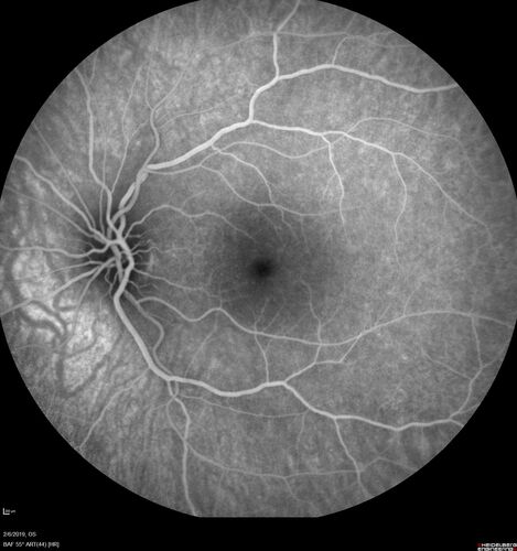 PIC which evolved into Subretinal Fibrosis
27 year old female  VA 20/200 right eye 20/20 left eye.  Right was treated with lucentis.  When extended to 3 months, the fibrosis got much worse
