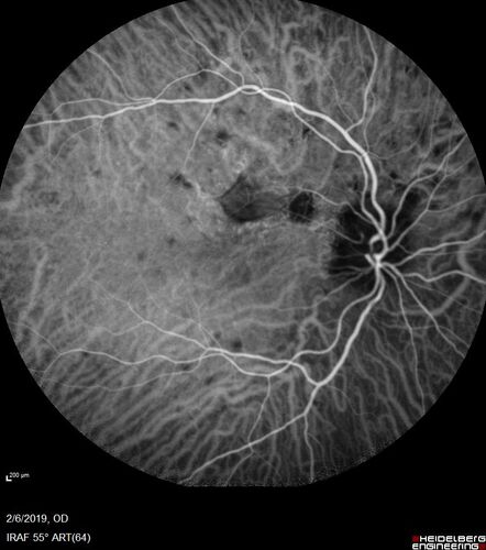 PIC which evolved into Subretinal Fibrosis
27 year old female  VA 20/200 right eye 20/20 left eye.  Right was treated with lucentis.  When extended to 3 months, the fibrosis got much worse
