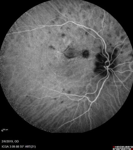 PIC which evolved into Subretinal Fibrosis
27 year old female  VA 20/200 right eye 20/20 left eye.  Right was treated with lucentis.  When extended to 3 months, the fibrosis got much worse
