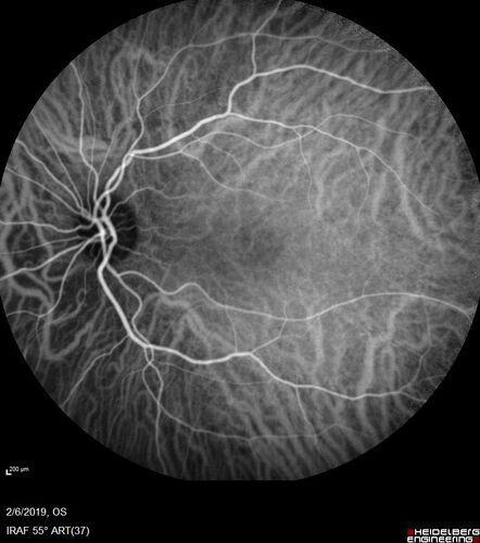 PIC which evolved into Subretinal Fibrosis
27 year old female  VA 20/200 right eye 20/20 left eye.  Right was treated with lucentis.  When extended to 3 months, the fibrosis got much worse
