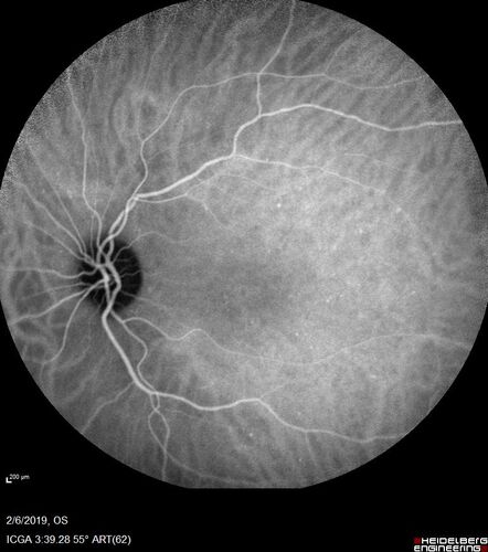 PIC which evolved into Subretinal Fibrosis
27 year old female  VA 20/200 right eye 20/20 left eye.  Right was treated with lucentis.  When extended to 3 months, the fibrosis got much worse
