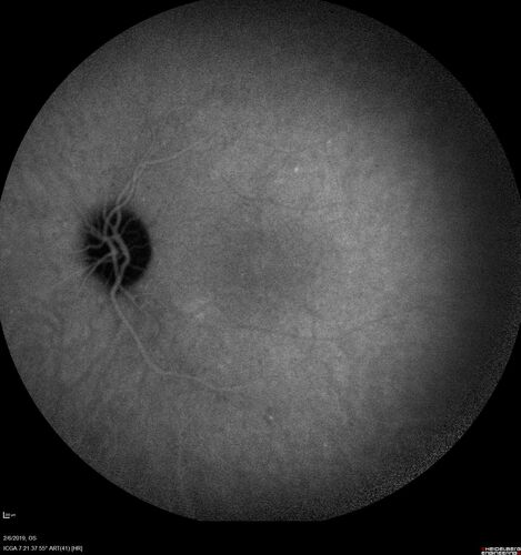 PIC which evolved into Subretinal Fibrosis
27 year old female  VA 20/200 right eye 20/20 left eye.  Right was treated with lucentis.  When extended to 3 months, the fibrosis got much worse
