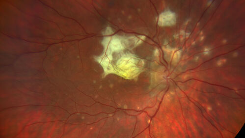 PIC which evolved into Subretinal Fibrosis
27 year old female  VA 20/200 right eye 20/20 left eye.  Right was treated with lucentis.  When extended to 3 months, the fibrosis got much worse
