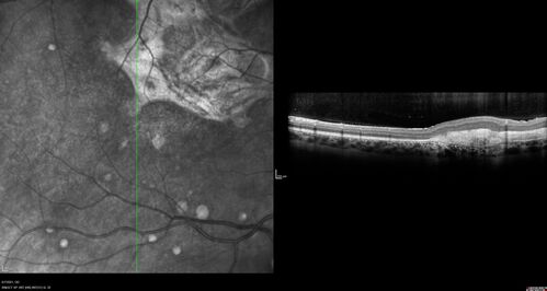 PIC which evolved into Subretinal Fibrosis
27 year old female  VA 20/200 right eye 20/20 left eye.  Right was treated with lucentis.  When extended to 3 months, the fibrosis got much worse
