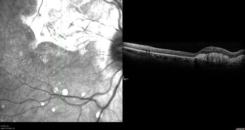 PIC which evolved into Subretinal Fibrosis
27 year old female  VA 20/200 right eye 20/20 left eye.  Right was treated with lucentis.  When extended to 3 months, the fibrosis got much worse
