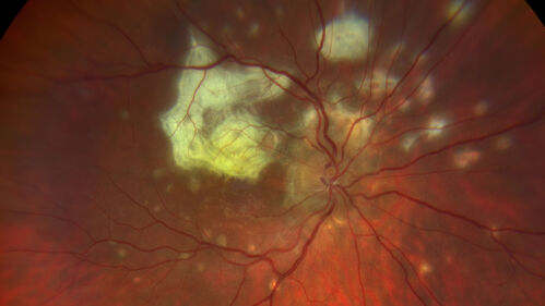 PIC which evolved into Subretinal Fibrosis
27 year old female  VA 20/200 right eye 20/20 left eye.  Right was treated with lucentis.  When extended to 3 months, the fibrosis got much worse
