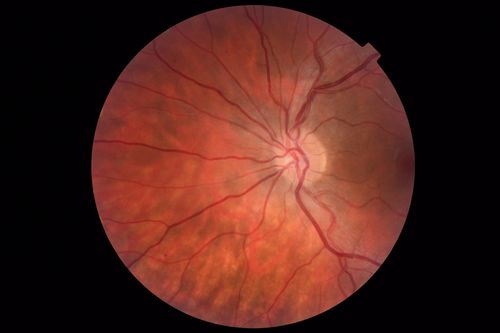 Punctate Inner Choroidopathy and Choroidal Neovascular Membrane
27 year old female with vision loss for 4 months. VA was 20/200.  She had a CNVM which was extrafoveal with no subretinal fluid.  Her vision improved over 6 months to 20/50 with Ranibizumab injections (she might have improved without treatment)
