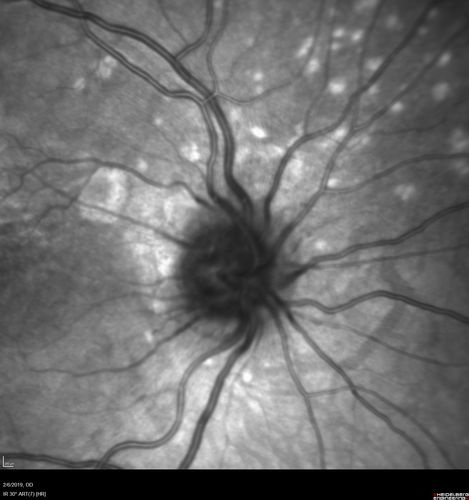 Punctate Inner Choroidopathy and Choroidal Neovascular Membrane
27 year old female with vision loss for 4 months. VA was 20/200.  She had a CNVM which was extrafoveal with no subretinal fluid.  Her vision improved over 6 months to 20/50 with Ranibizumab injections (she might have improved without treatment)
