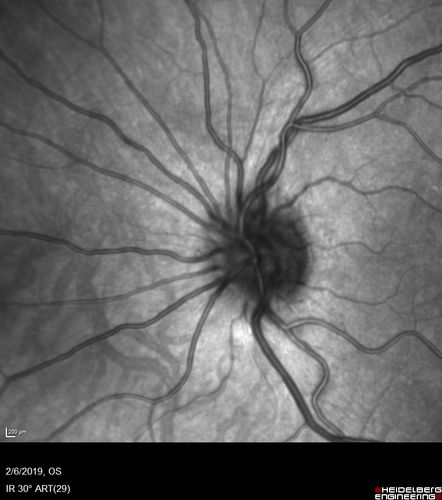 Punctate Inner Choroidopathy and Choroidal Neovascular Membrane
27 year old female with vision loss for 4 months. VA was 20/200.  She had a CNVM which was extrafoveal with no subretinal fluid.  Her vision improved over 6 months to 20/50 with Ranibizumab injections (she might have improved without treatment)
