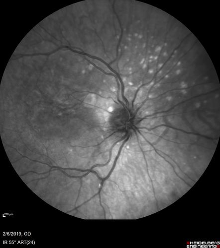 Punctate Inner Choroidopathy and Choroidal Neovascular Membrane
27 year old female with vision loss for 4 months. VA was 20/200.  She had a CNVM which was extrafoveal with no subretinal fluid.  Her vision improved over 6 months to 20/50 with Ranibizumab injections (she might have improved without treatment)
