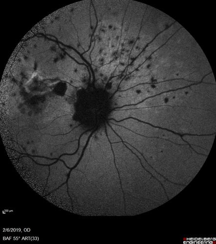 Punctate Inner Choroidopathy and Choroidal Neovascular Membrane
27 year old female with vision loss for 4 months. VA was 20/200.  She had a CNVM which was extrafoveal with no subretinal fluid.  Her vision improved over 6 months to 20/50 with Ranibizumab injections (she might have improved without treatment)
