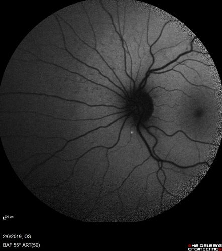 Punctate Inner Choroidopathy and Choroidal Neovascular Membrane
27 year old female with vision loss for 4 months. VA was 20/200.  She had a CNVM which was extrafoveal with no subretinal fluid.  Her vision improved over 6 months to 20/50 with Ranibizumab injections (she might have improved without treatment)
